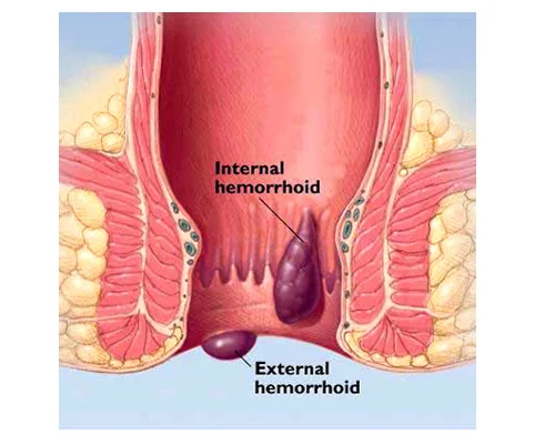bwasir kaisa hota hai image